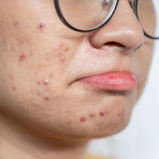 Start Your Journey to Clear Skin and Book an <a href="https://dmdskinsciences.com/products/email-consultation-with-dr-mike-d" target="_blank">Email Consultation</a> Now!