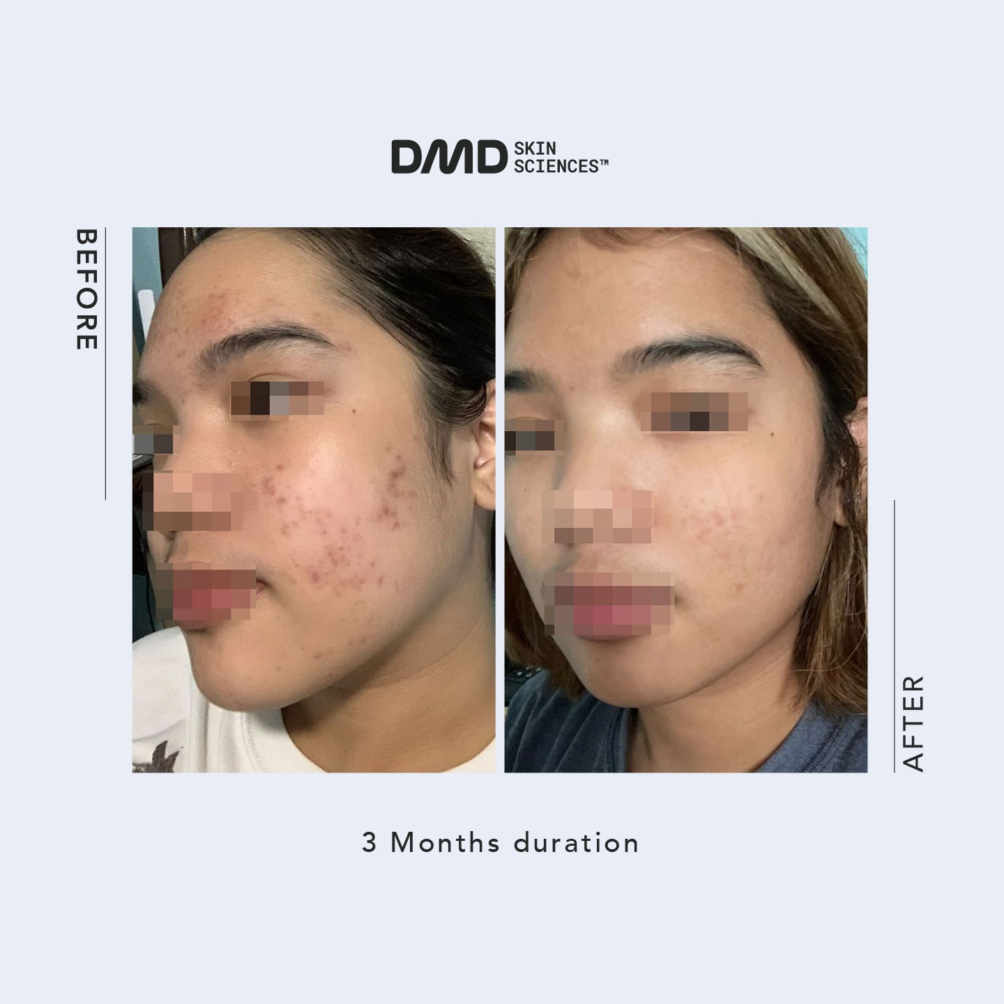 Email Consultation with Dr. Mike D - Acne / Acne Scars / Hyperpigmentation