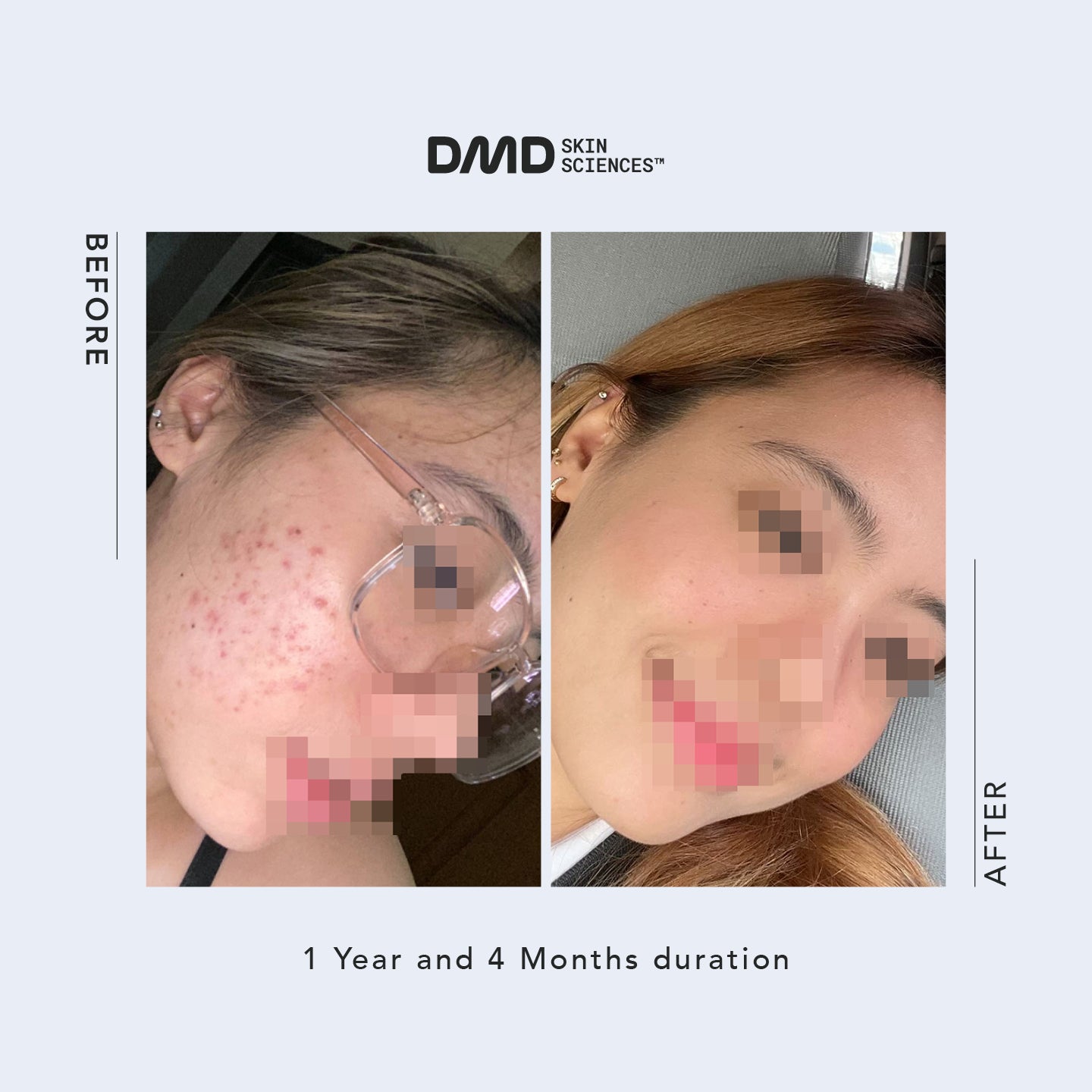 Email Consultation with Dr. Mike D - Acne / Acne Scars / Hyperpigmentation