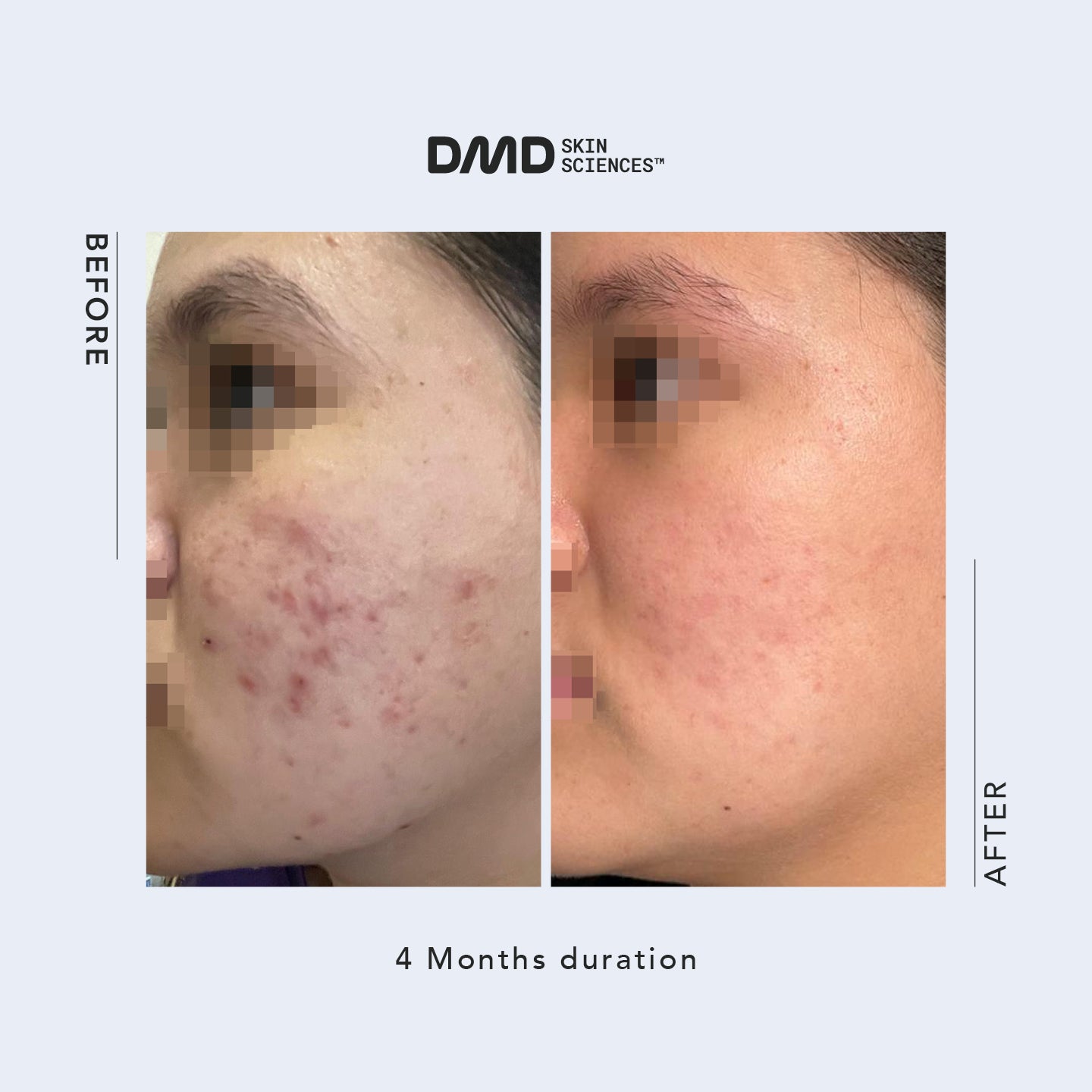 Email Consultation with Dr. Mike D - Acne / Acne Scars / Hyperpigmentation