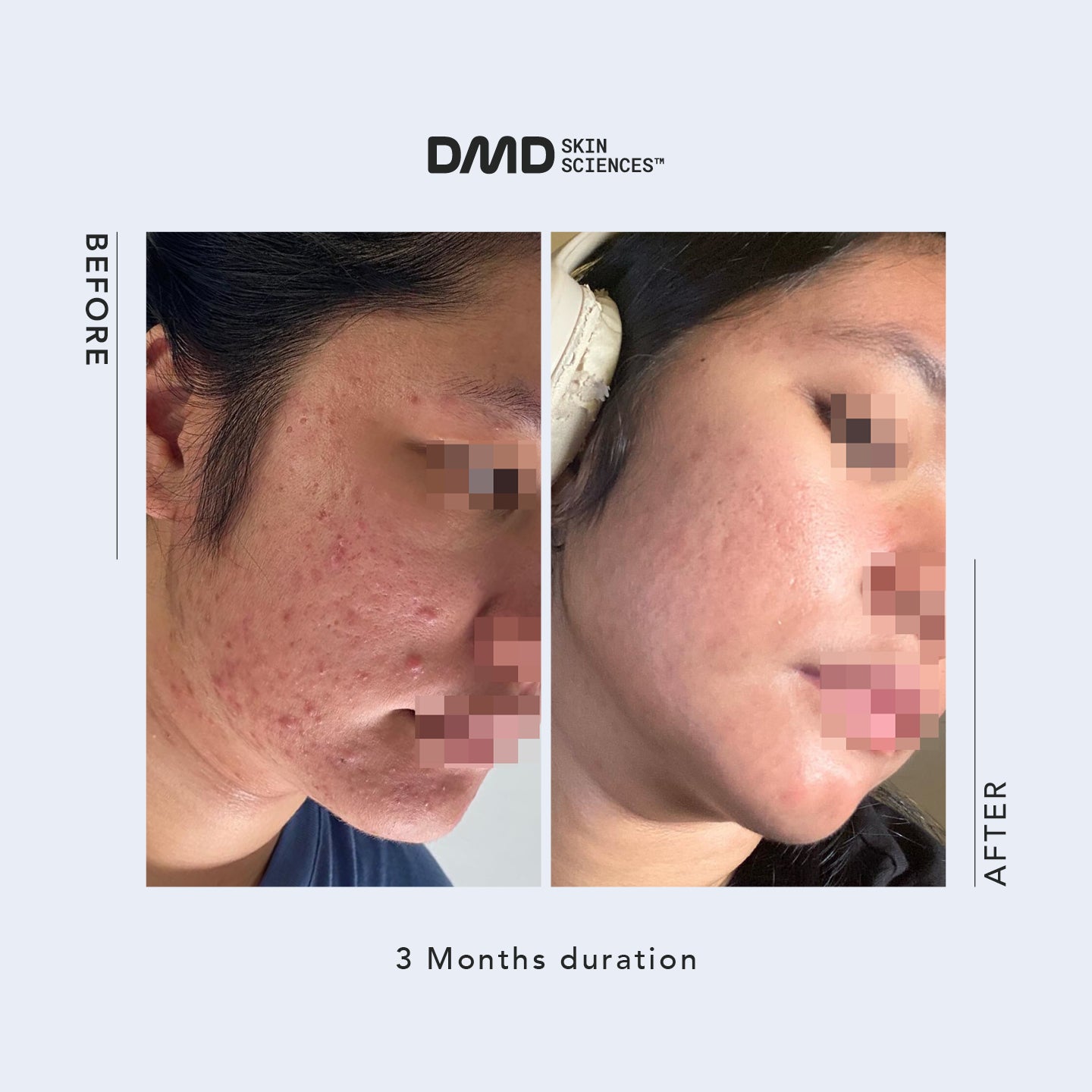 Email Consultation with Dr. Mike D - Acne / Acne Scars / Hyperpigmentation