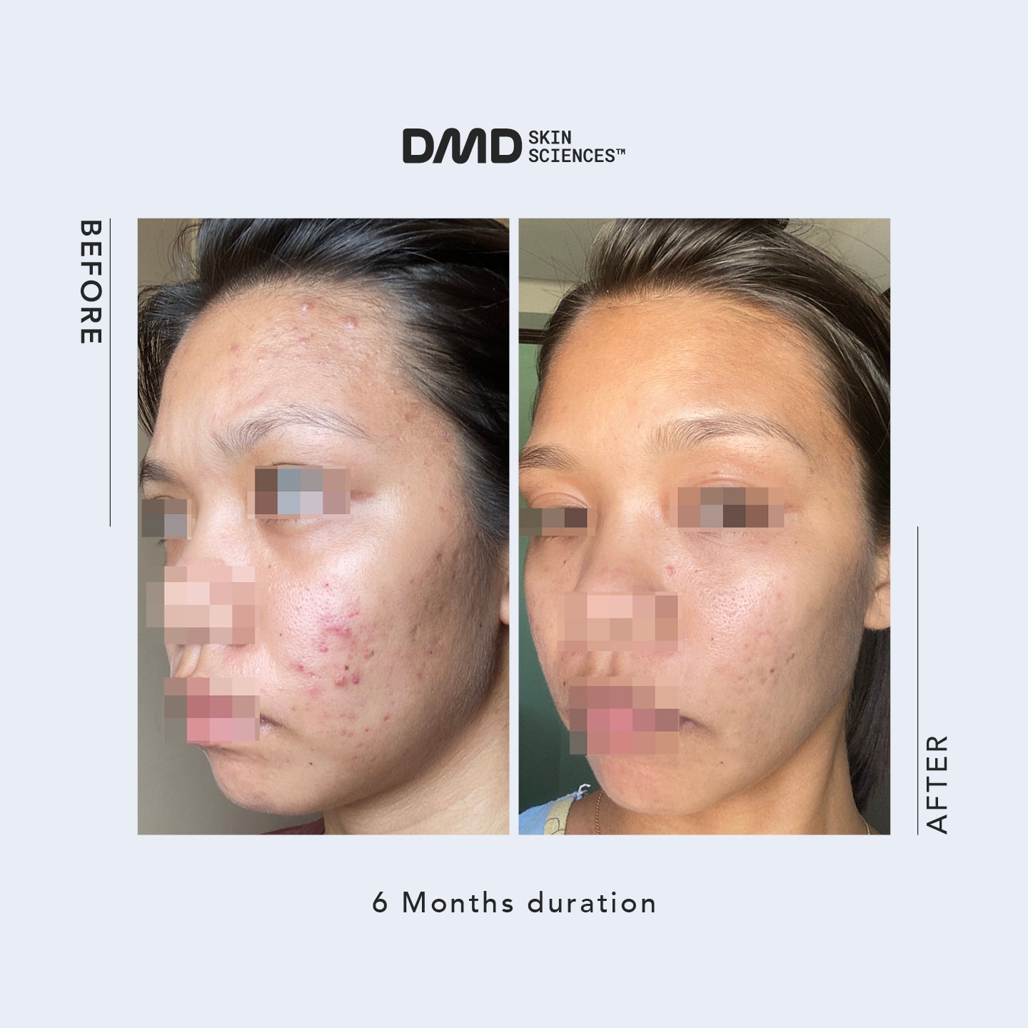 Email Consultation with Dr. Mike D - Acne / Acne Scars / Hyperpigmentation