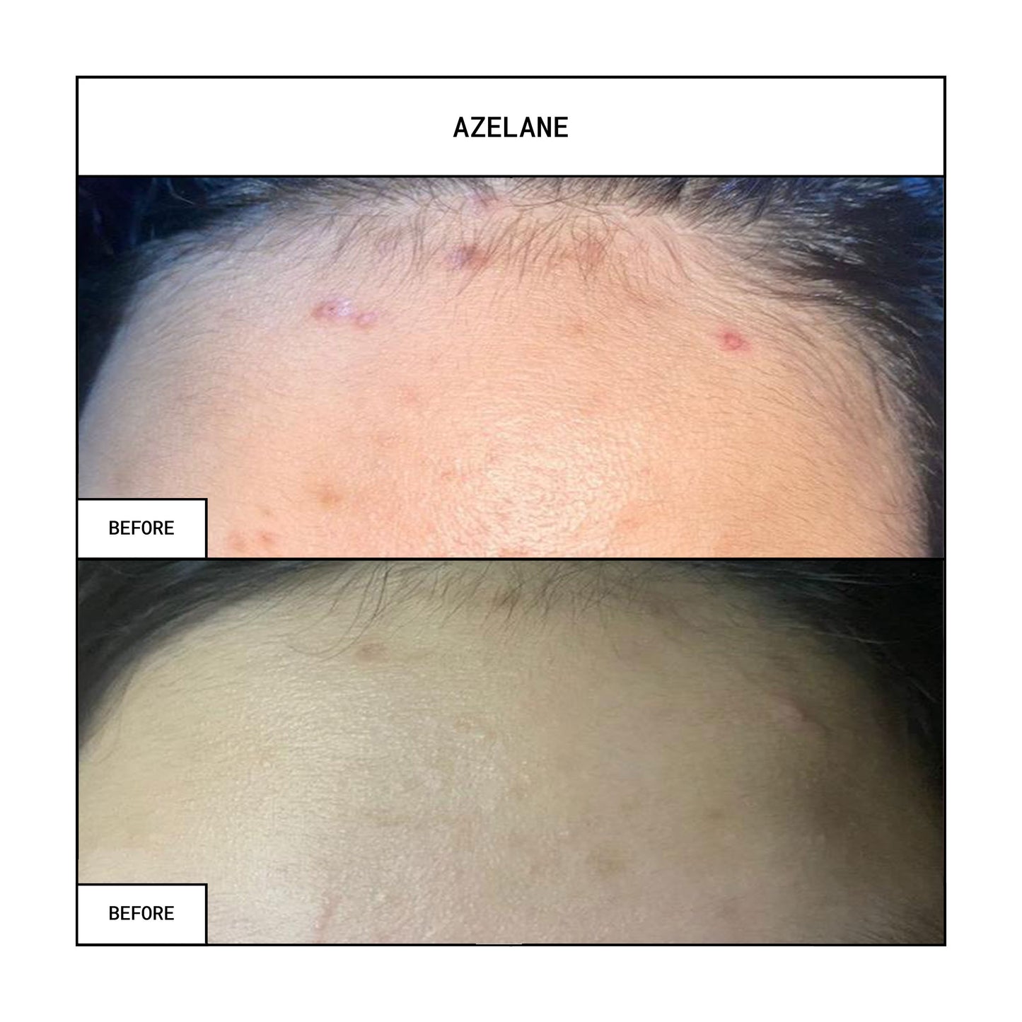 AZELANE Clinical Whitening Soap 100g