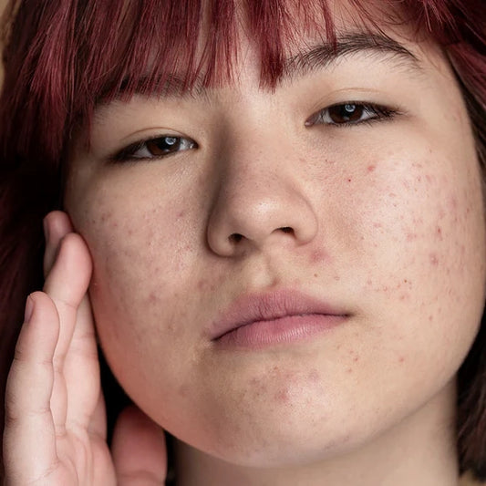 Understanding the Causes of Acne