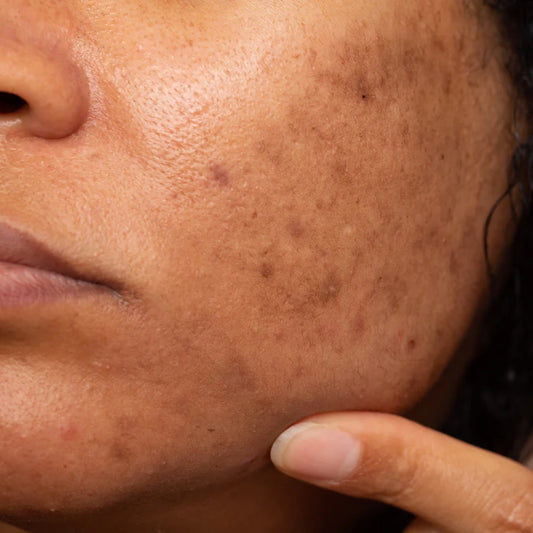 Tranexamic Acid & Dark Acne Marks