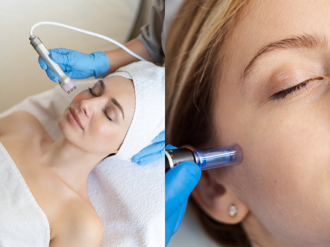 Alternative Acne Scar Treatment: Lasers & Microneedling